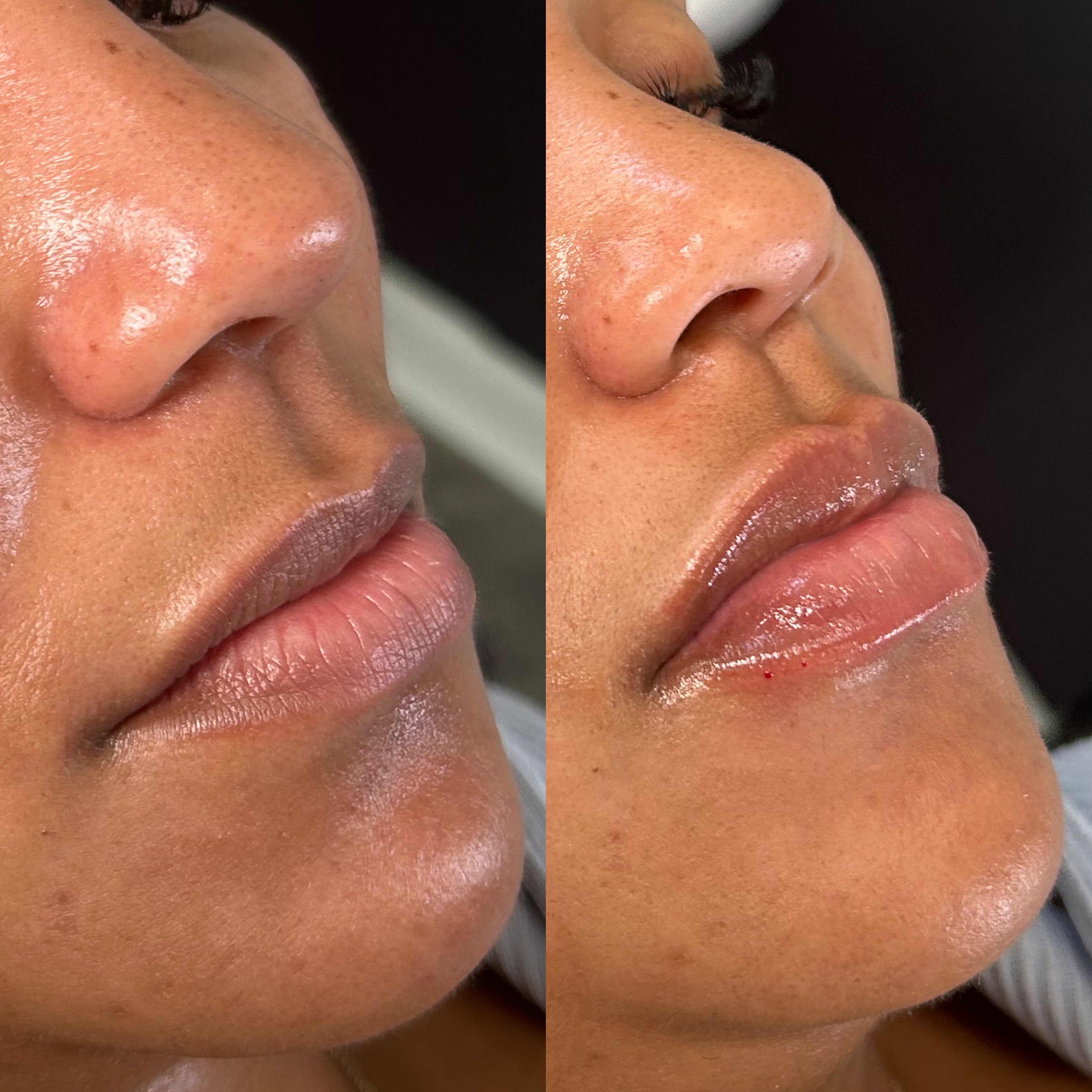 Lip Filler Before and After