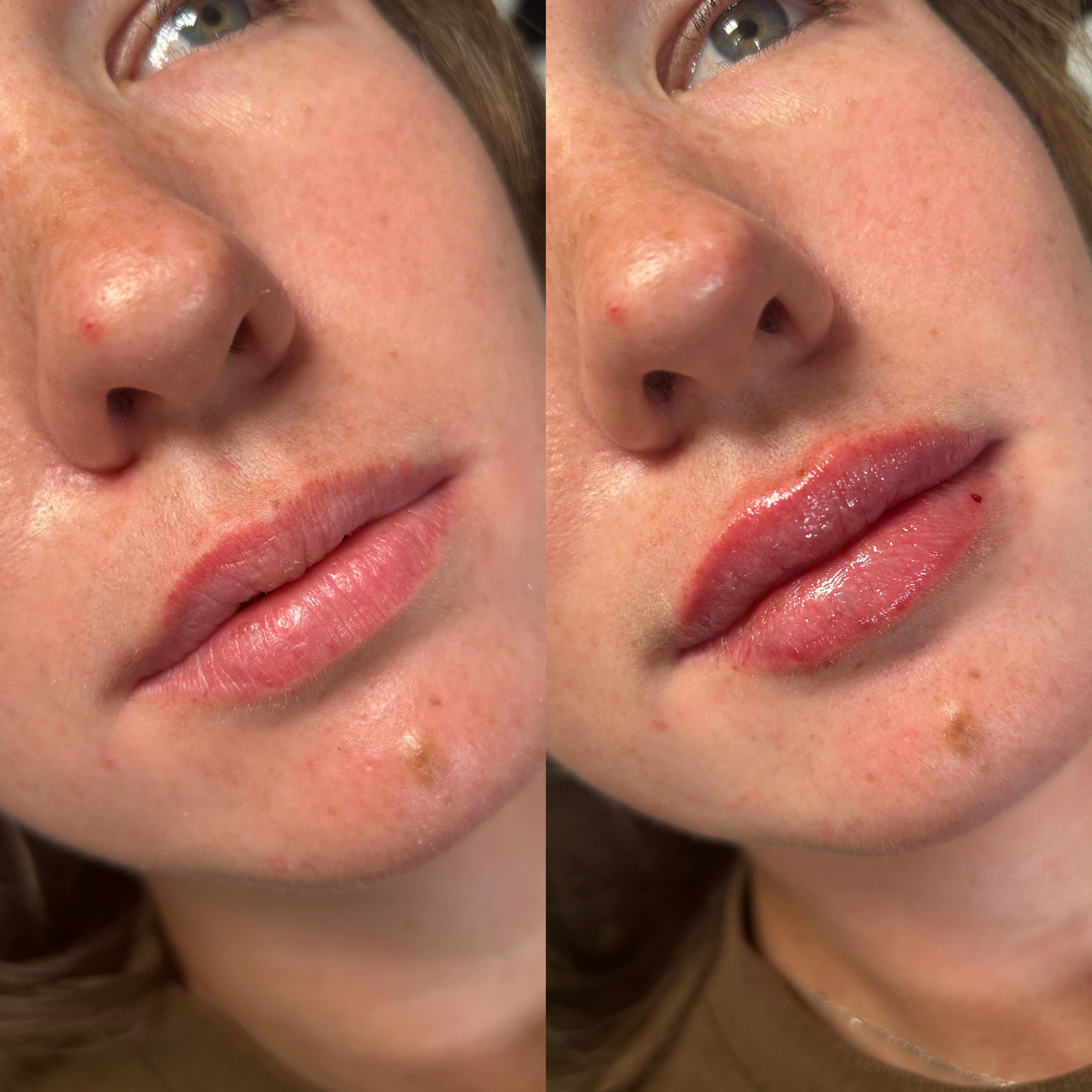 Lip Filler Before and After
