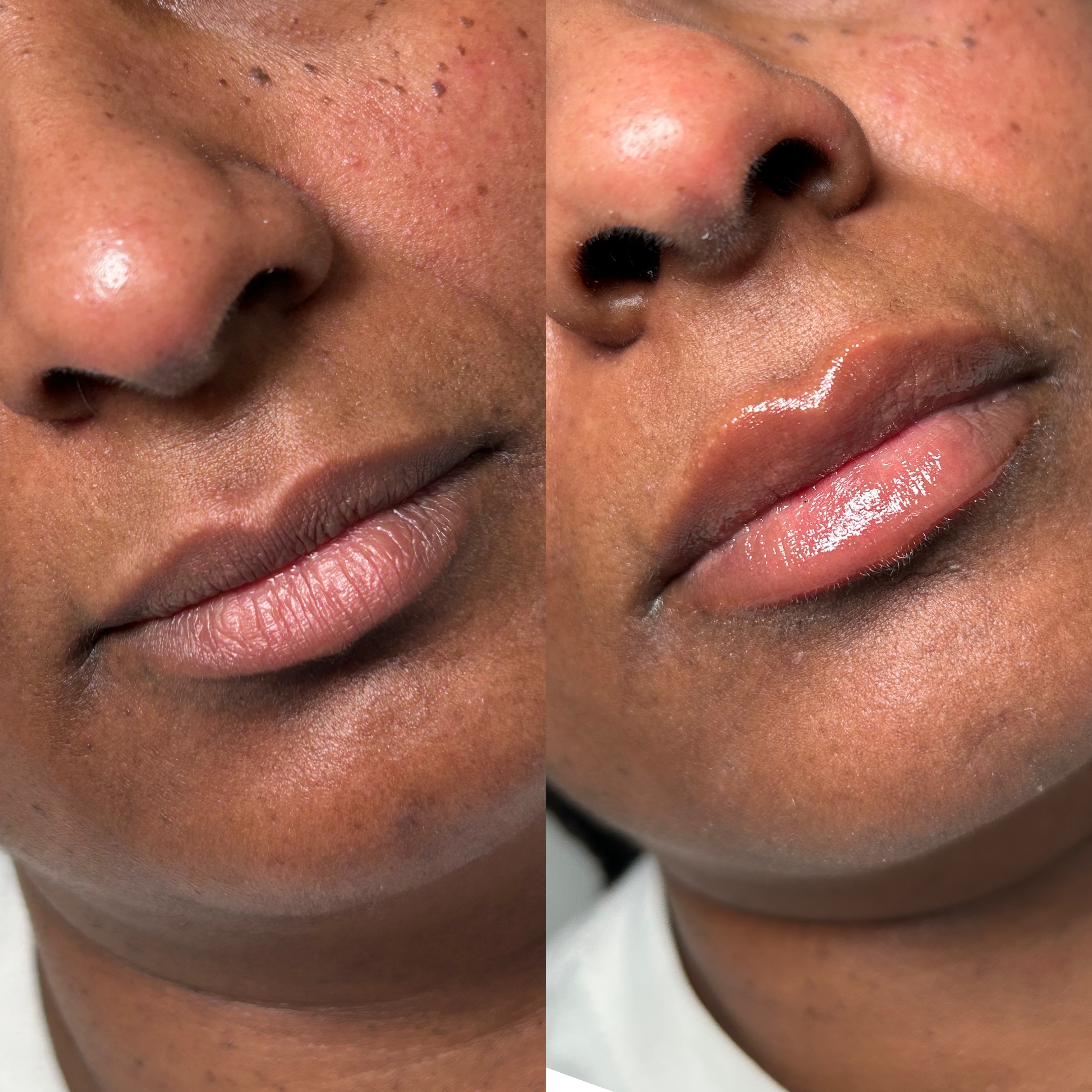 Lip Filler Before and After