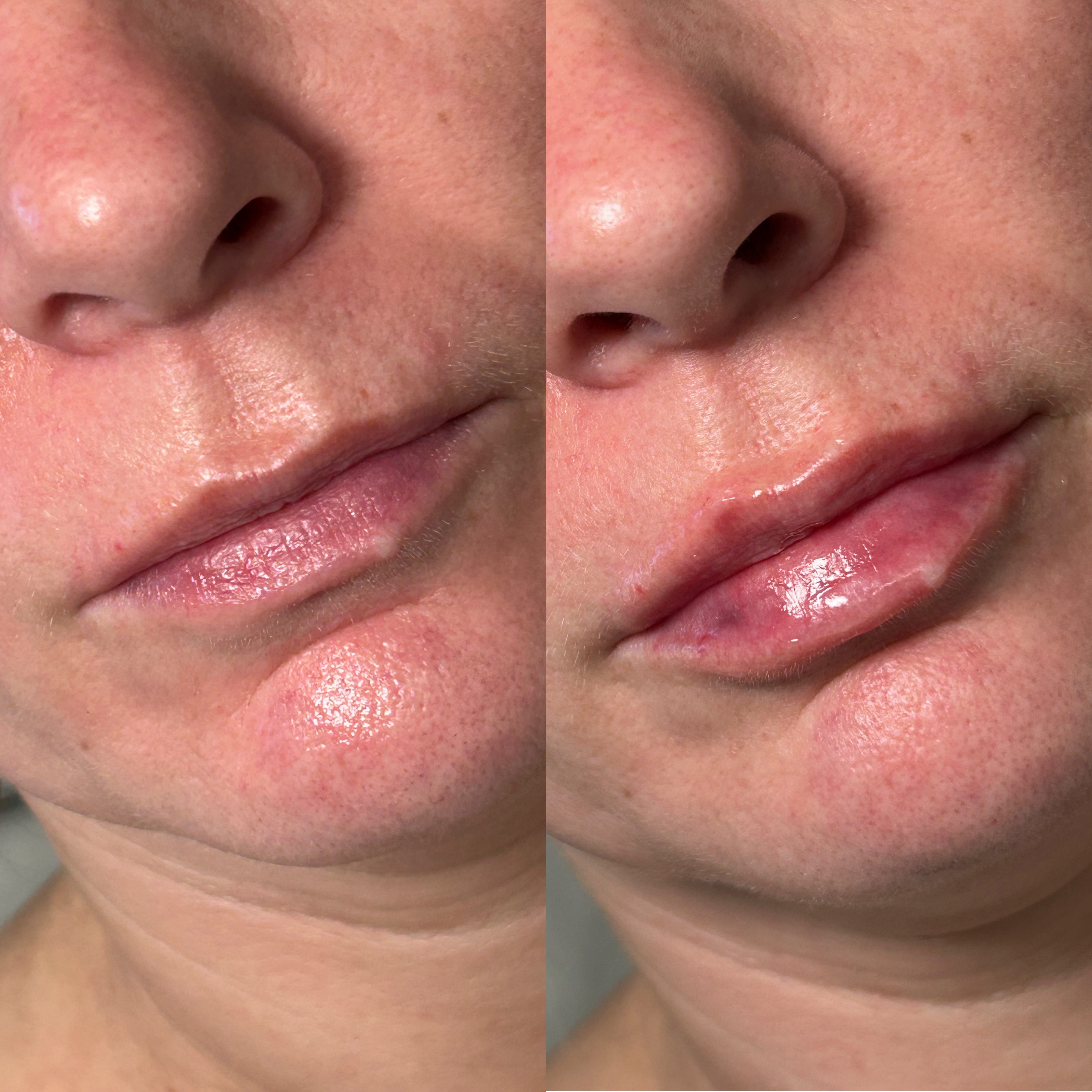 Lip Filler Before and After