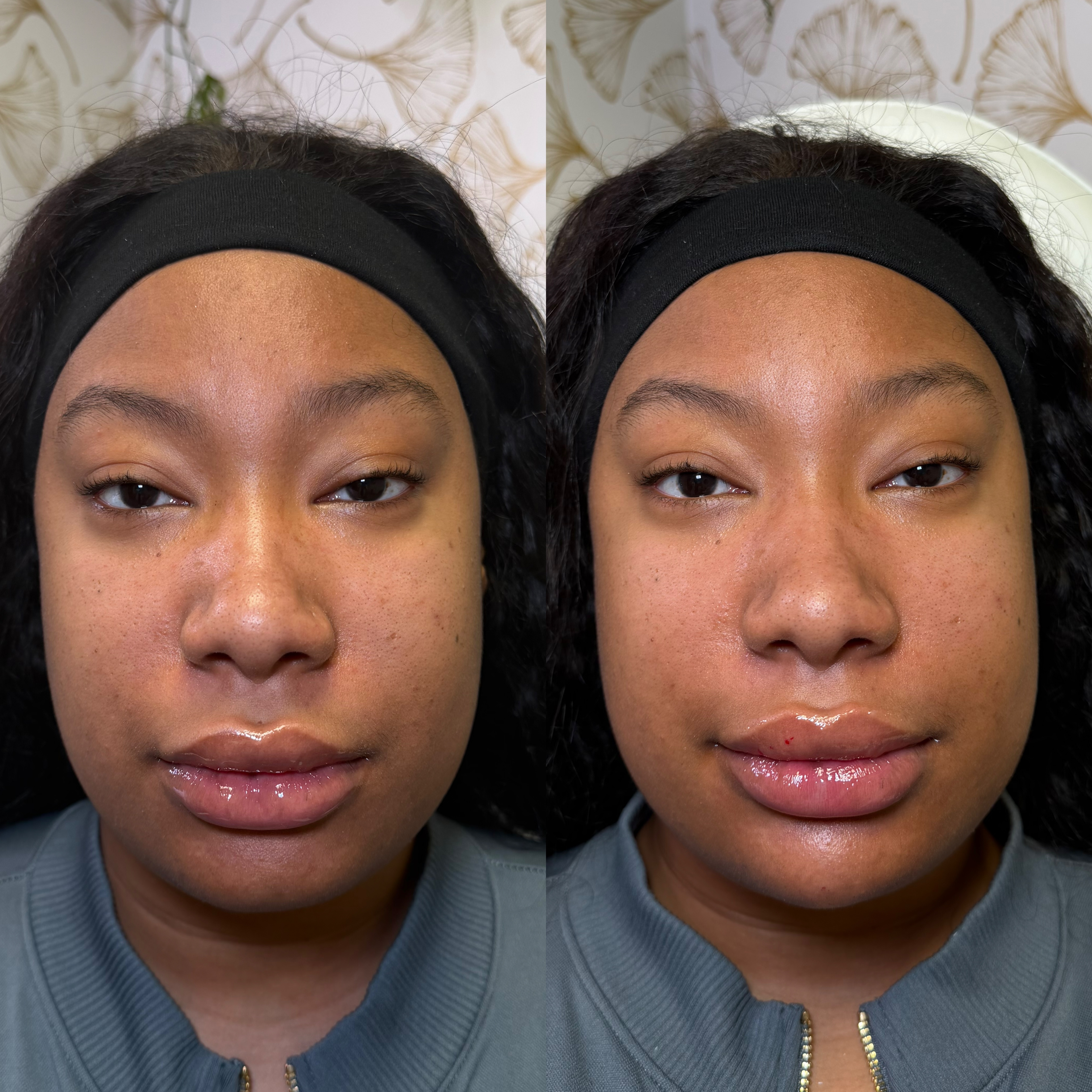 Facial Balancing Before and After