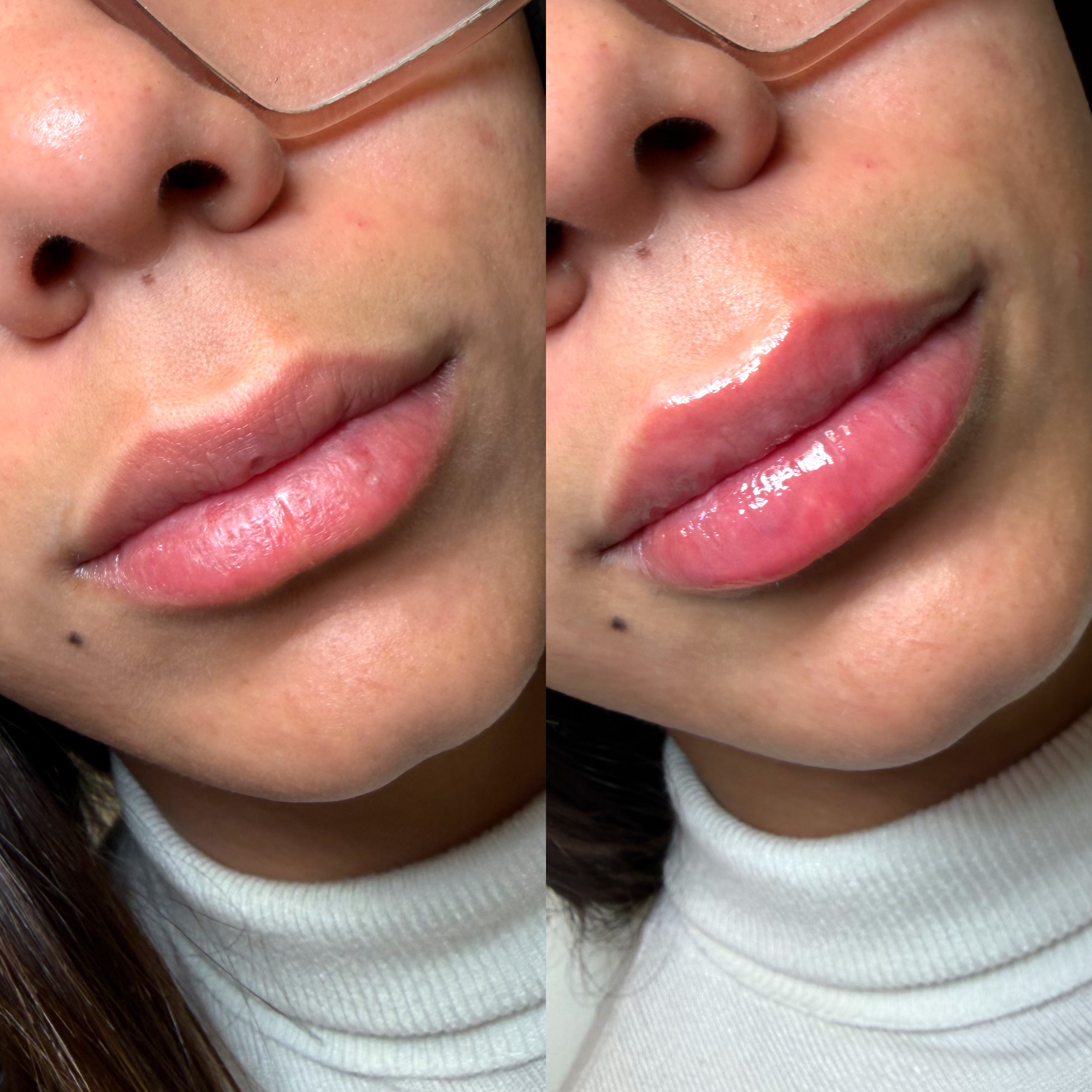 Lip Filler Before and After