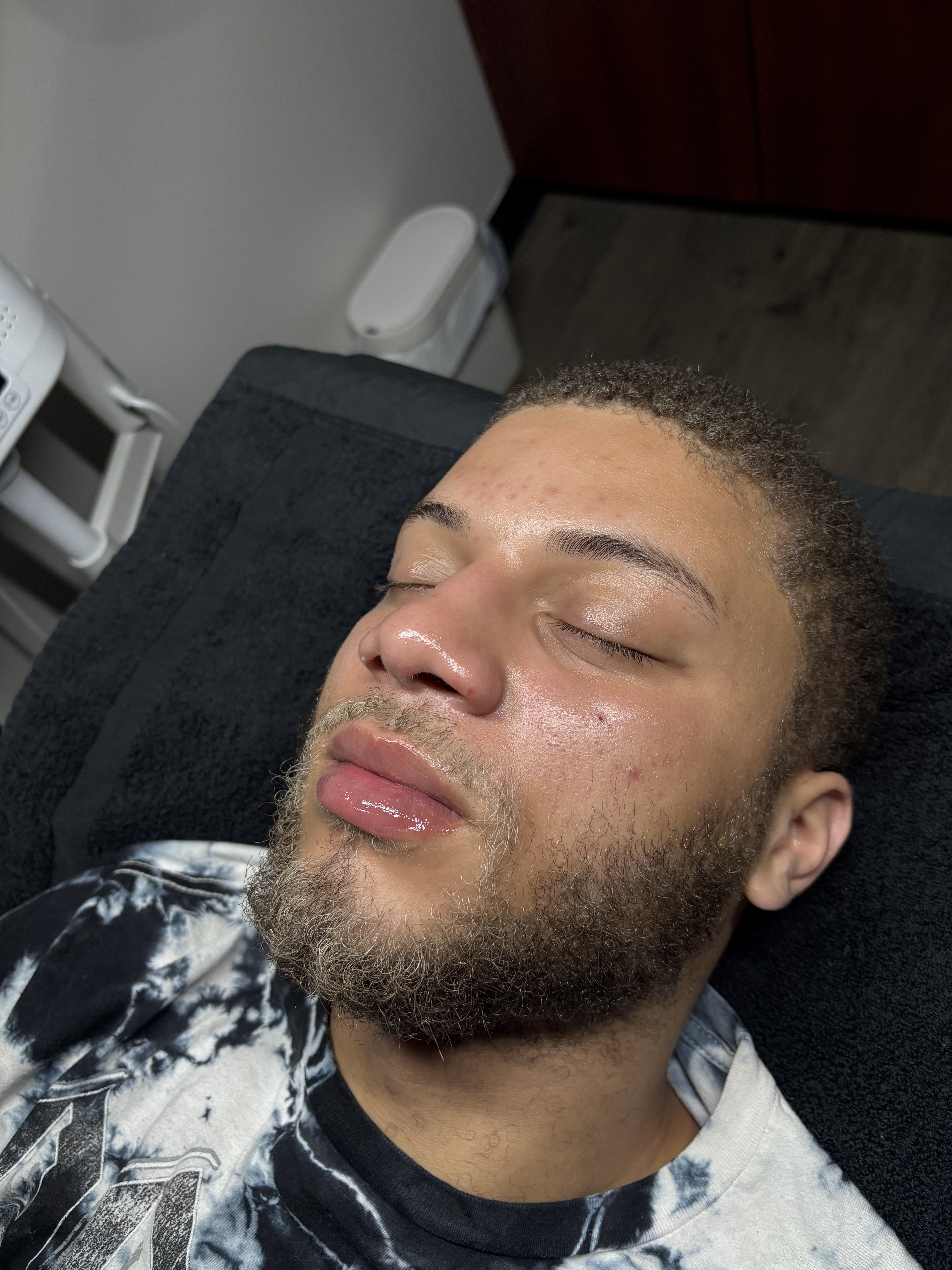 Lip Filler Result