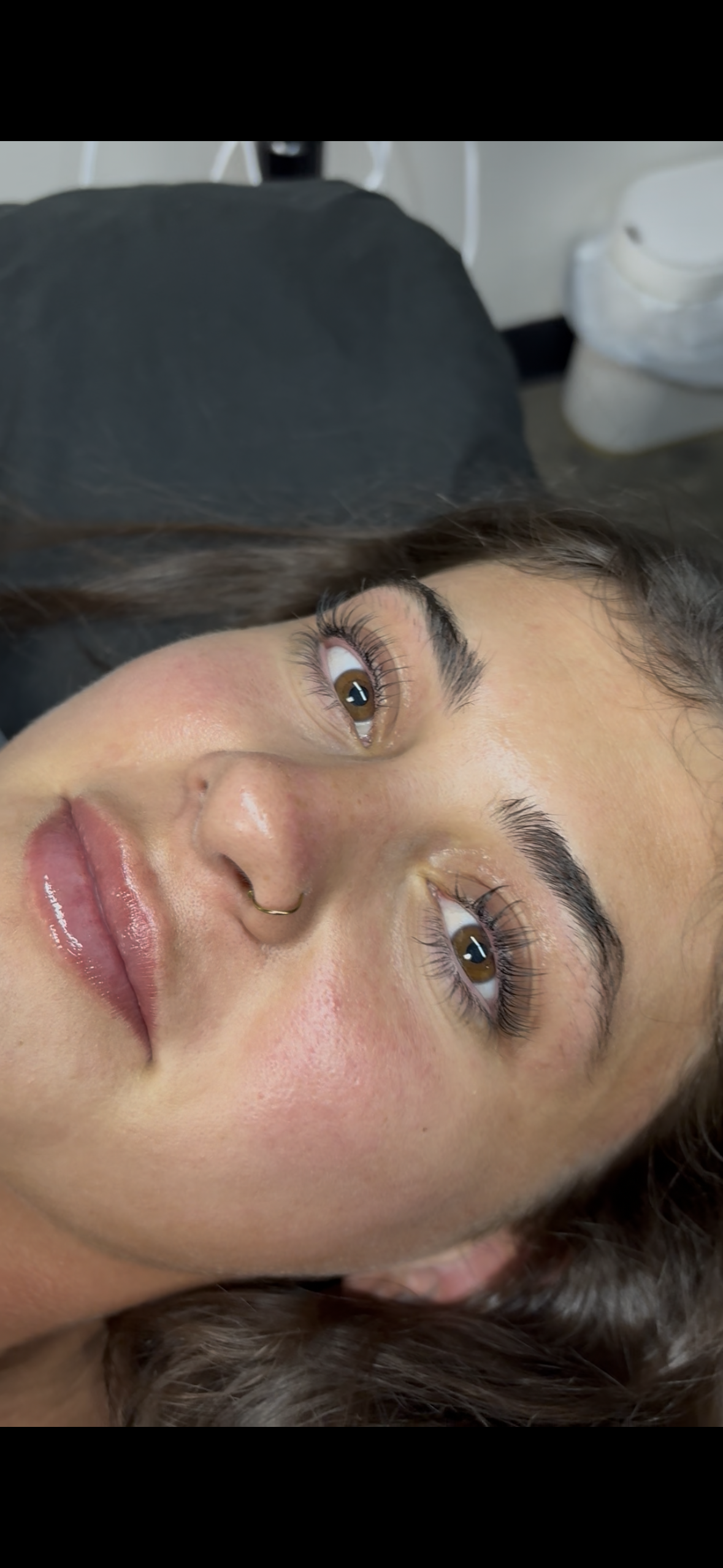 Lip Filler Result