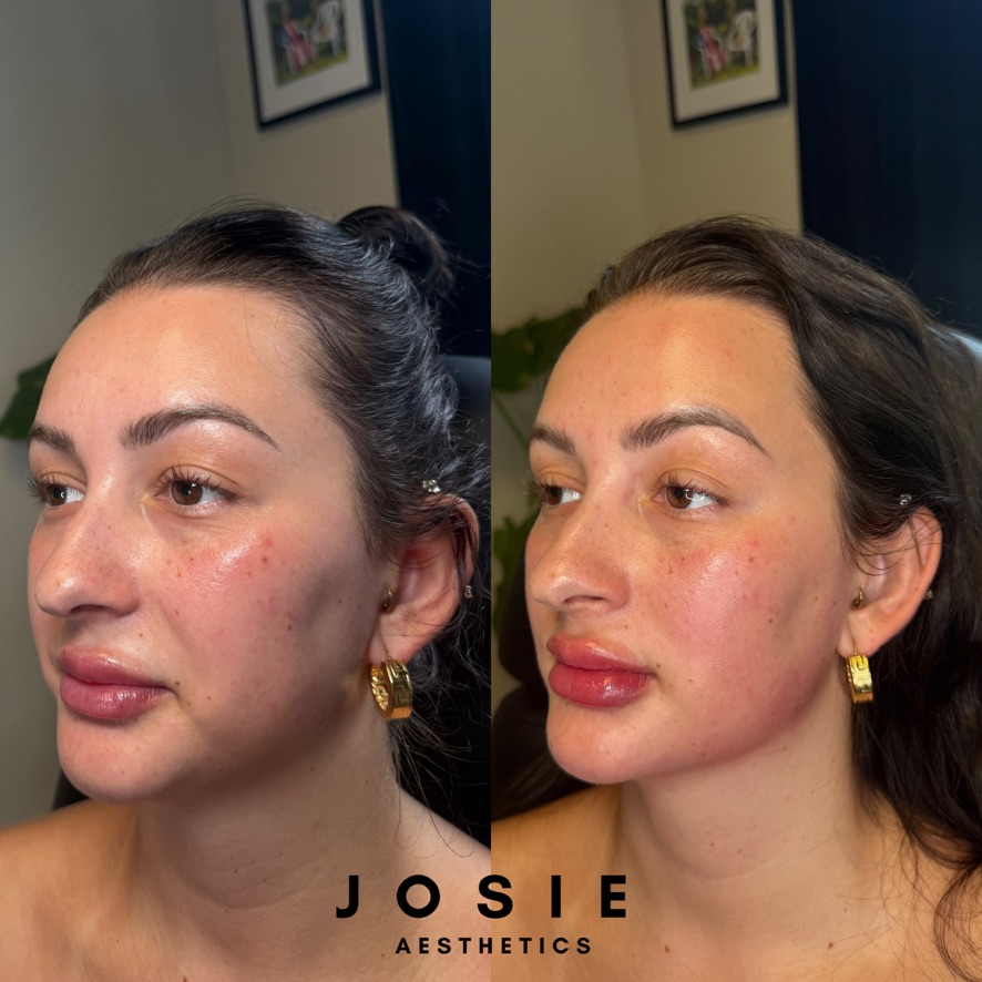 Facial Balancing Before and After