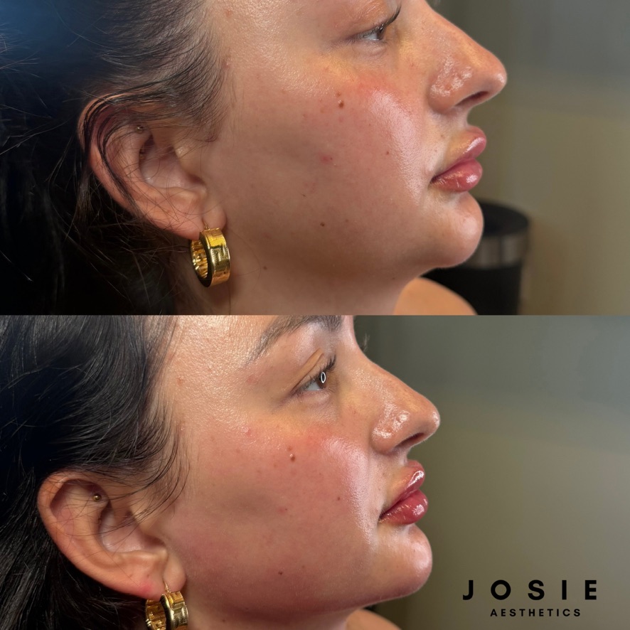 Facial Balancing Before and After