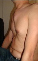 Photograph of pectus excavatum (a sunken chest deformity) in a person with Marfan syndrome.