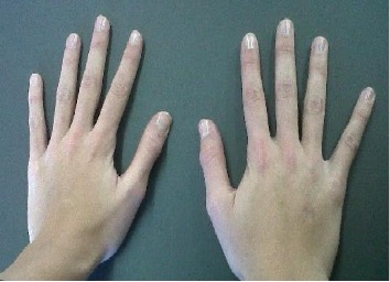 Photograph of arachnodactyly (“spider fingers”) — the unusually long, slender fingers seen in Marfan syndrome and related connective tissue disorders.