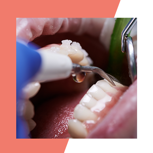 mountcrest-dental-dentist-near-you-dental-cleaning-hamilton