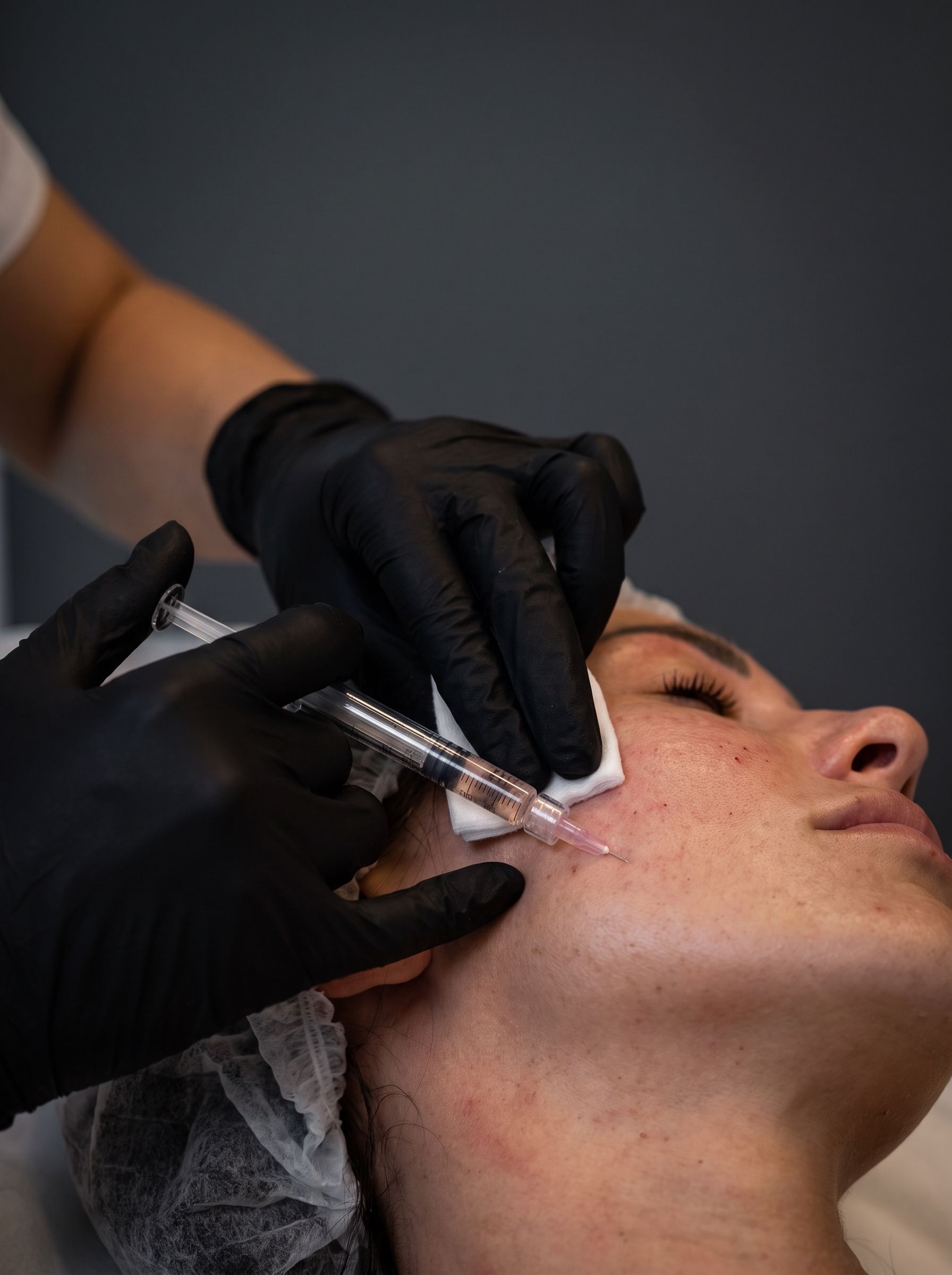 Mesotherapy at Derma Excellence, Shadman, Lahore