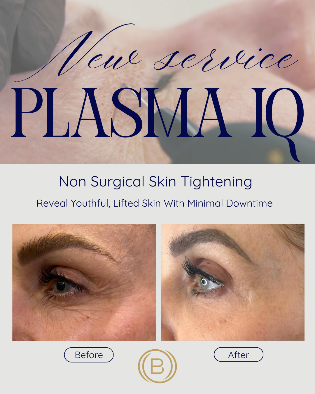 Plasma IQ Non-Surgical Skin Tightening