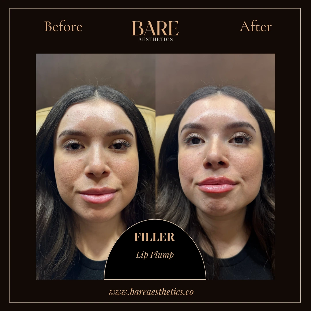 BARE Aesthetics Dermal Fillers