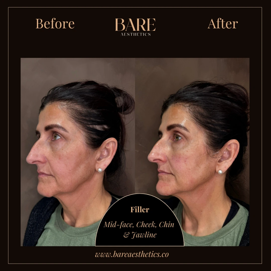 BARE Aesthetics Dermal Fillers