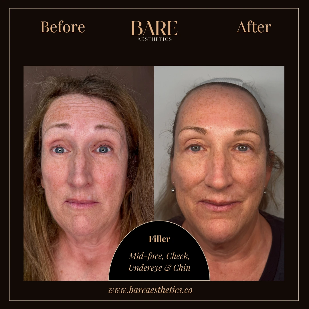 BARE Aesthetics Dermal Fillers
