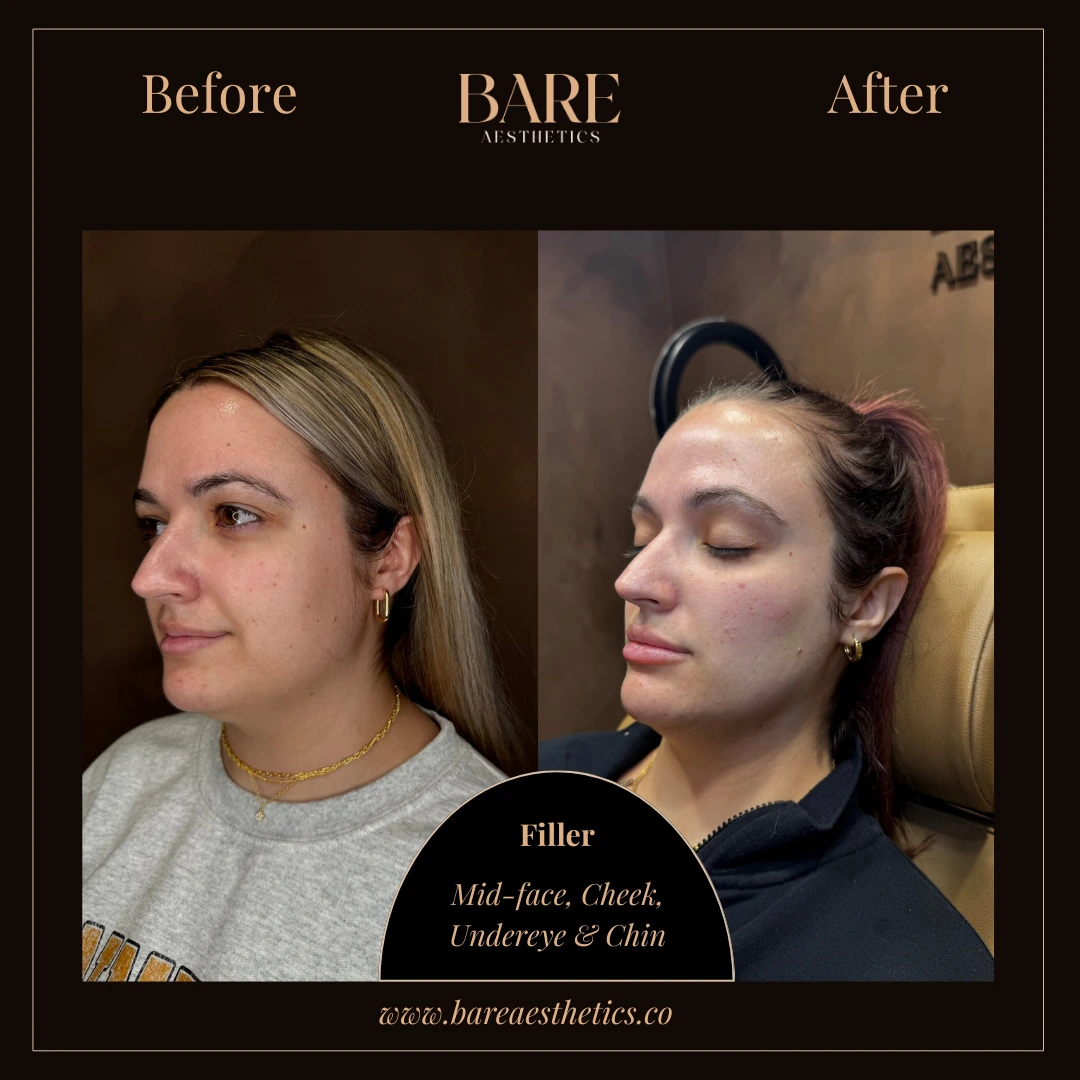 BARE Aesthetics Dermal Fillers