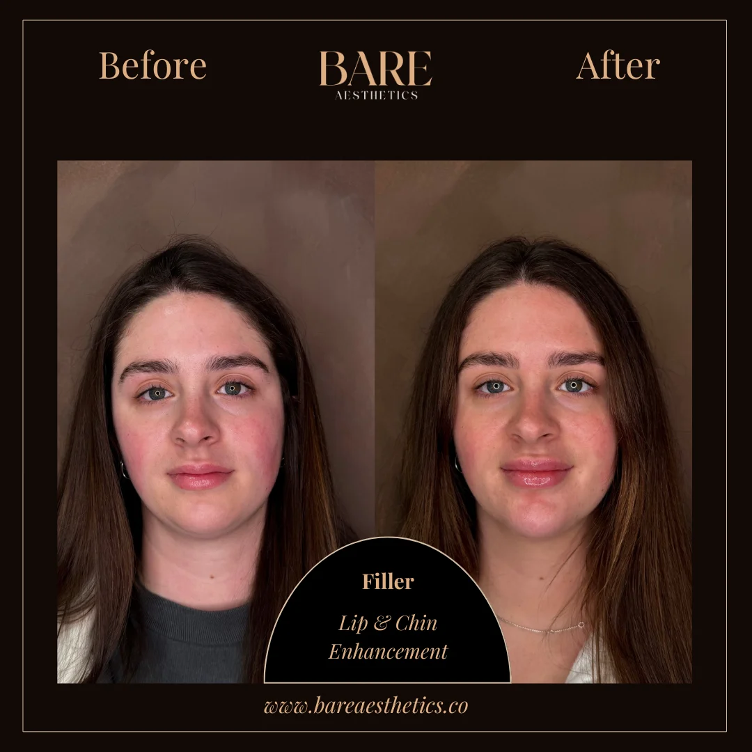 BARE Aesthetics Dermal Fillers