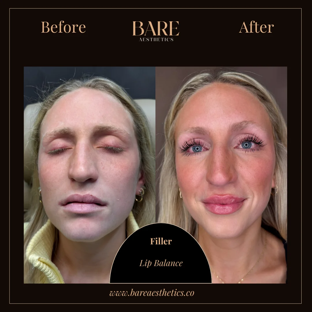 BARE Aesthetics Dermal Fillers