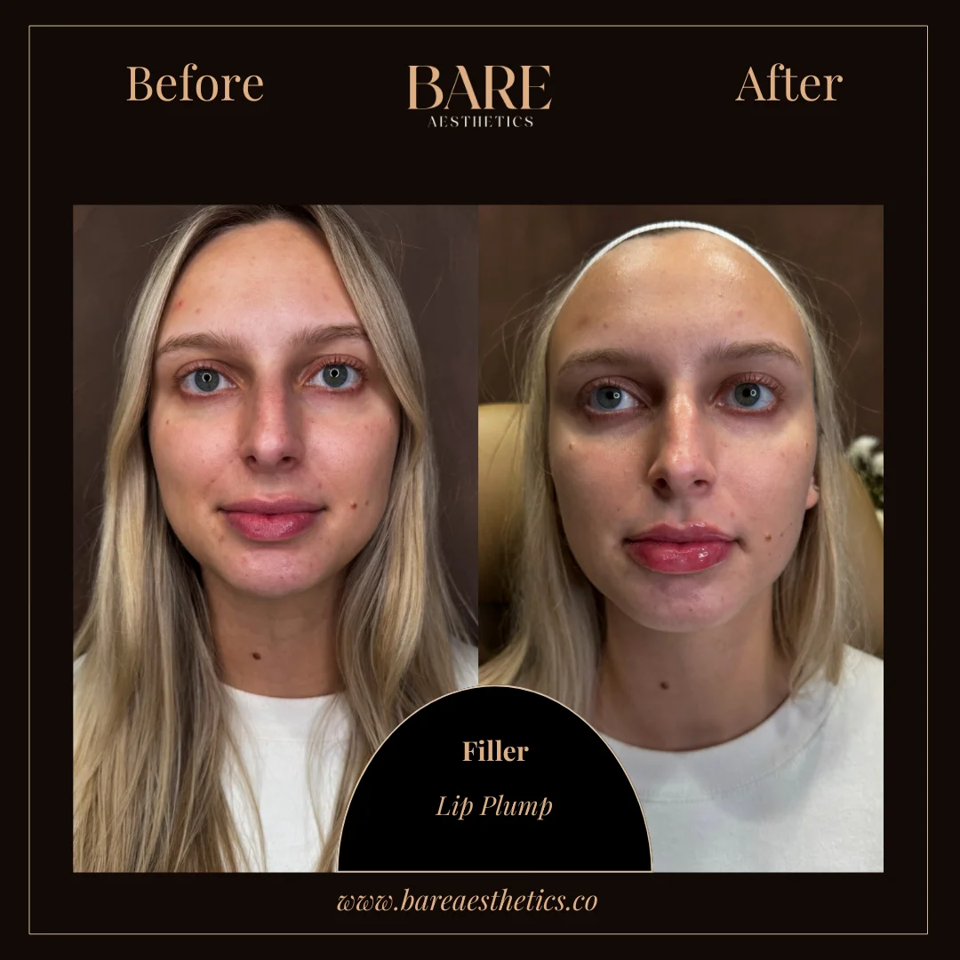 BARE Aesthetics Dermal Fillers