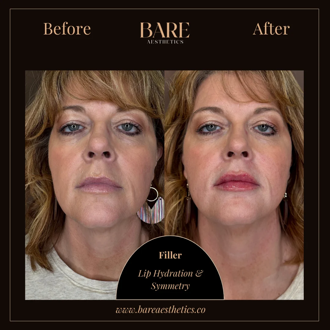 BARE Aesthetics Dermal Fillers