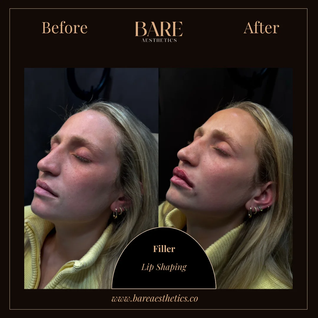 BARE Aesthetics Dermal Fillers