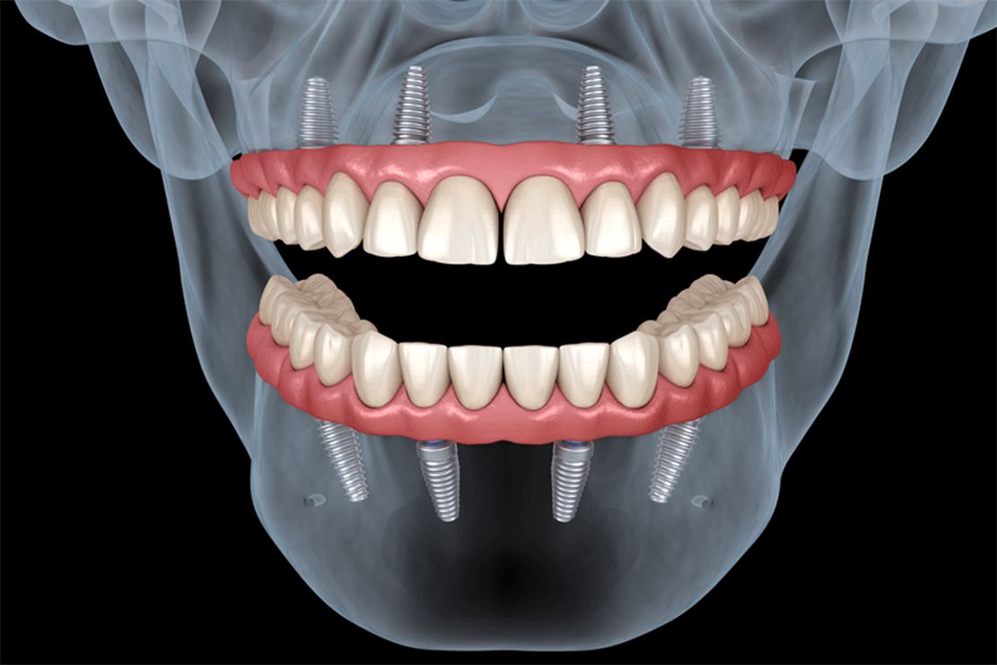 Illustration of the All-on-4 full-arch dental implant technique
