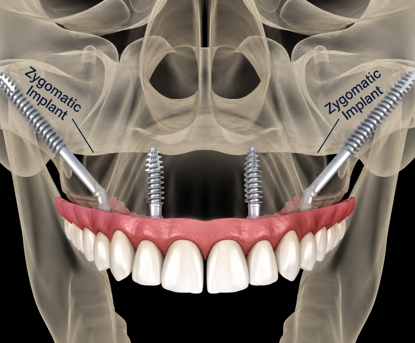 Illustration of zygomatic implants supporting an upper full-arch dental prosthesis