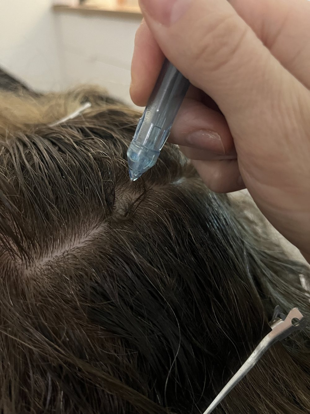 Infusion de la solution JETOP au jet sur le cuir chevelu, le long de la raie, à Aubagne