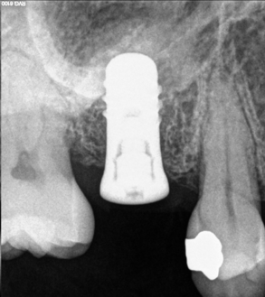 Dental X-ray showing a dental implant placed in the upper jaw near the sinus cavity.