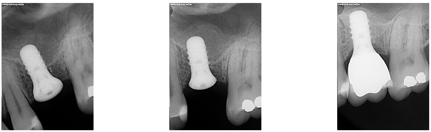 Series of dental X-rays showing the stages of a dental implant placement and restoration in the upper jaw, from implant insertion to final crown placement.