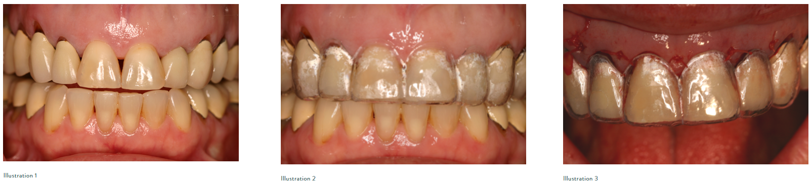 Three dental images showing stages of gum recession and tooth wear, including natural teeth, teeth covered with a protective dental splint, and a close-up of gums with a fitted dental guard.