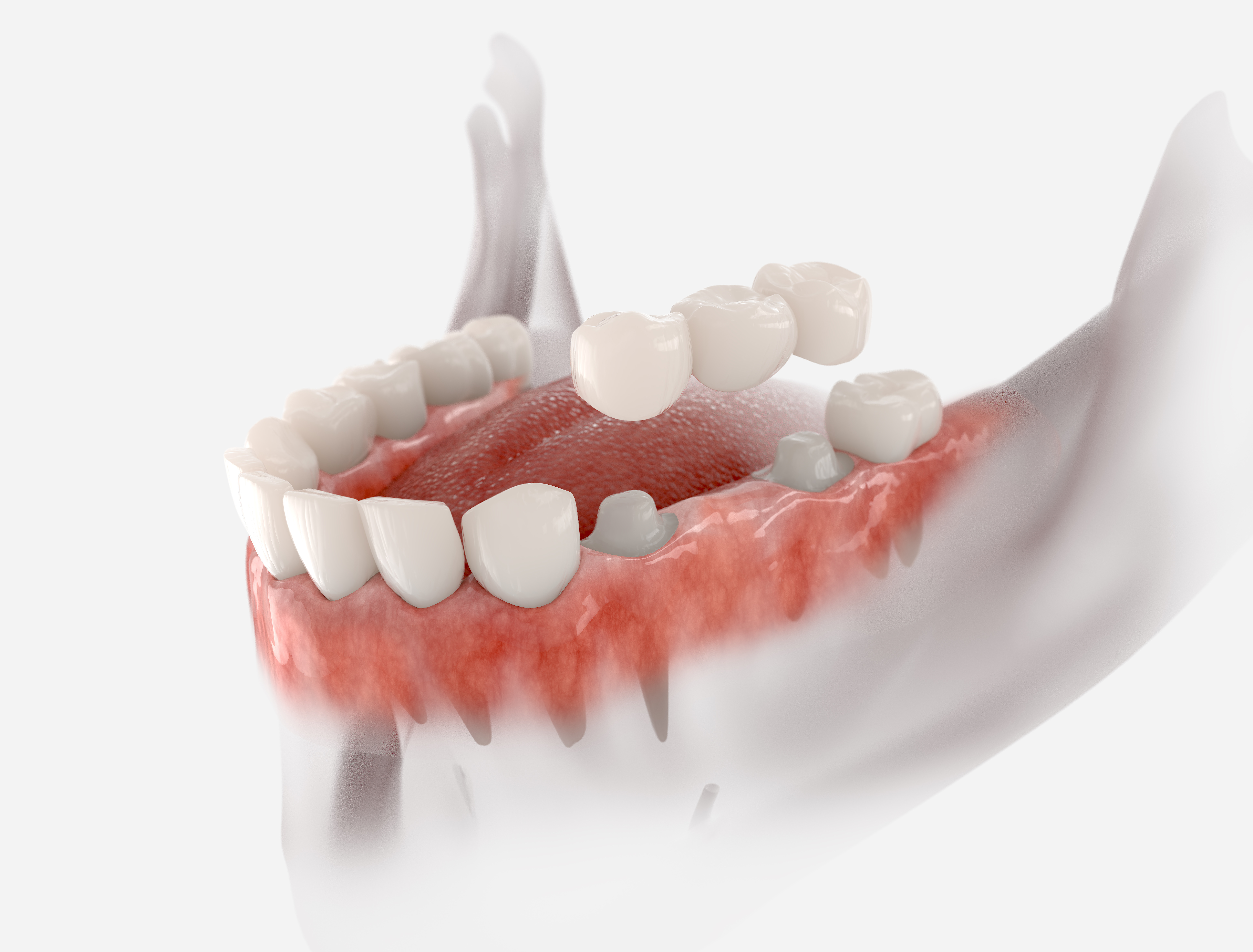 Dental bridge before and after at Woodyard Dental Care LLC Paducah Ky