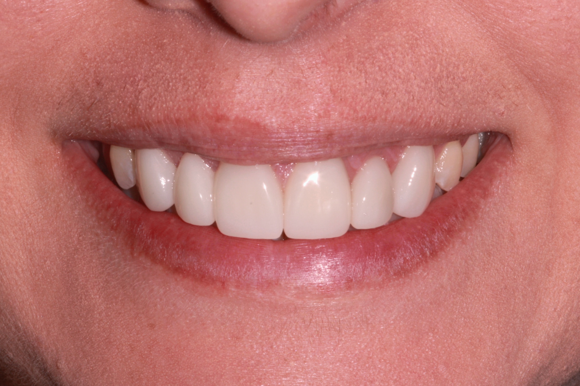 Dental Crown Lengthening