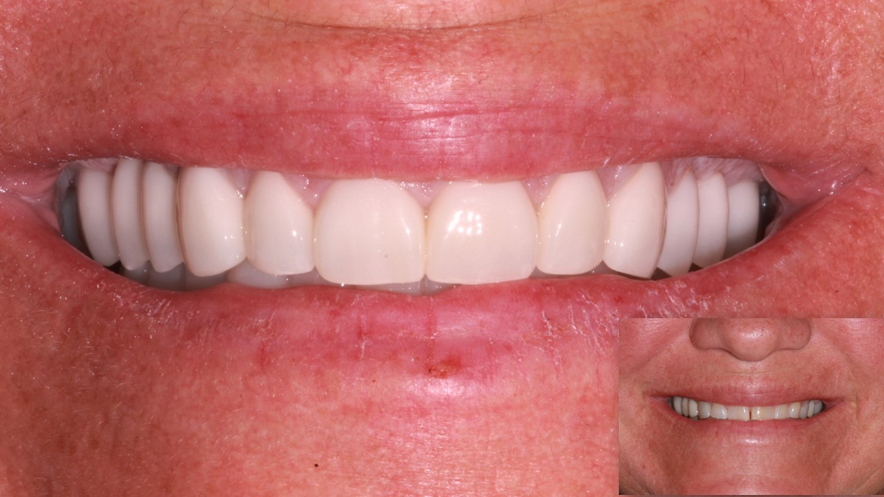 Veneers before and after, cosmetic dentistry Paducah Ky