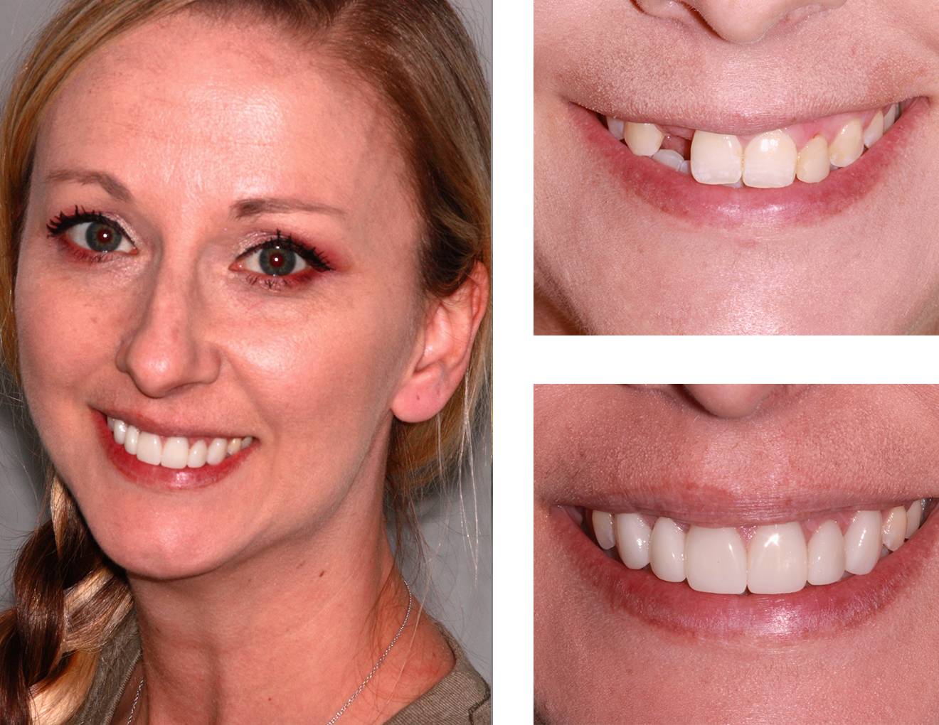 Crown Lengthening | dentist paducah ky | Woodyard Dental Care