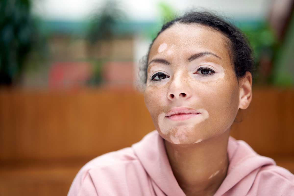 Rostro de una mujer joven con manchas de despigmentación características del vitíligo Rostro de una mujer joven con manchas de despigmentación características del vitíligo