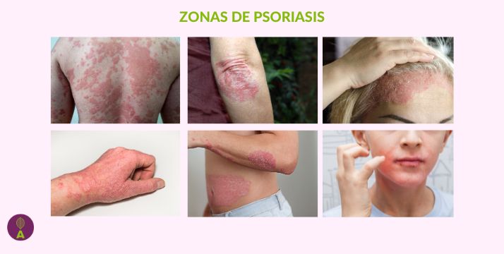 tipos de posriasis. Piel sana dermonutricion