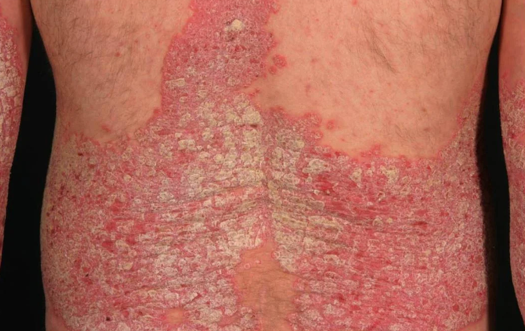 Psoriasis en la espalda