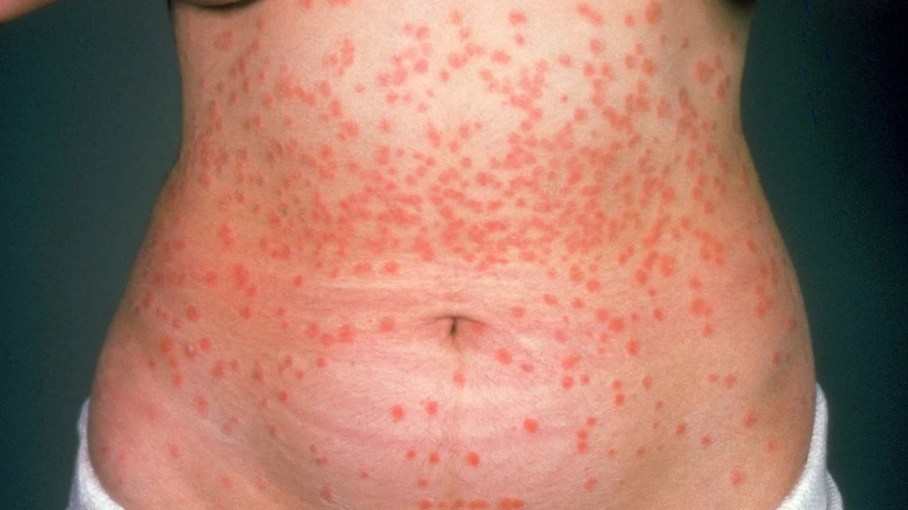 Psoriasis en gotas