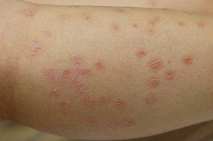 Psoriasis eritrodérmica