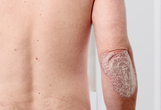 Psoriasis en placas