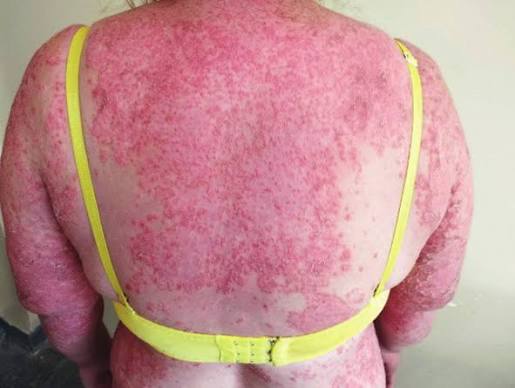 Psoriasis pustulosa