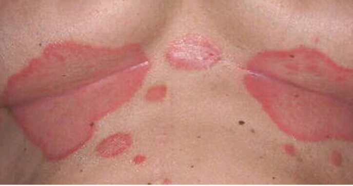 Psoriasis inversa