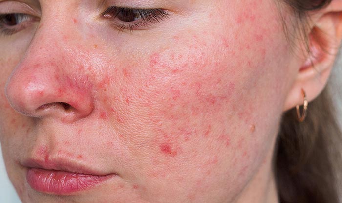 Mujer con rosácea. En busca d euna piel sana con Lola Demronutricion