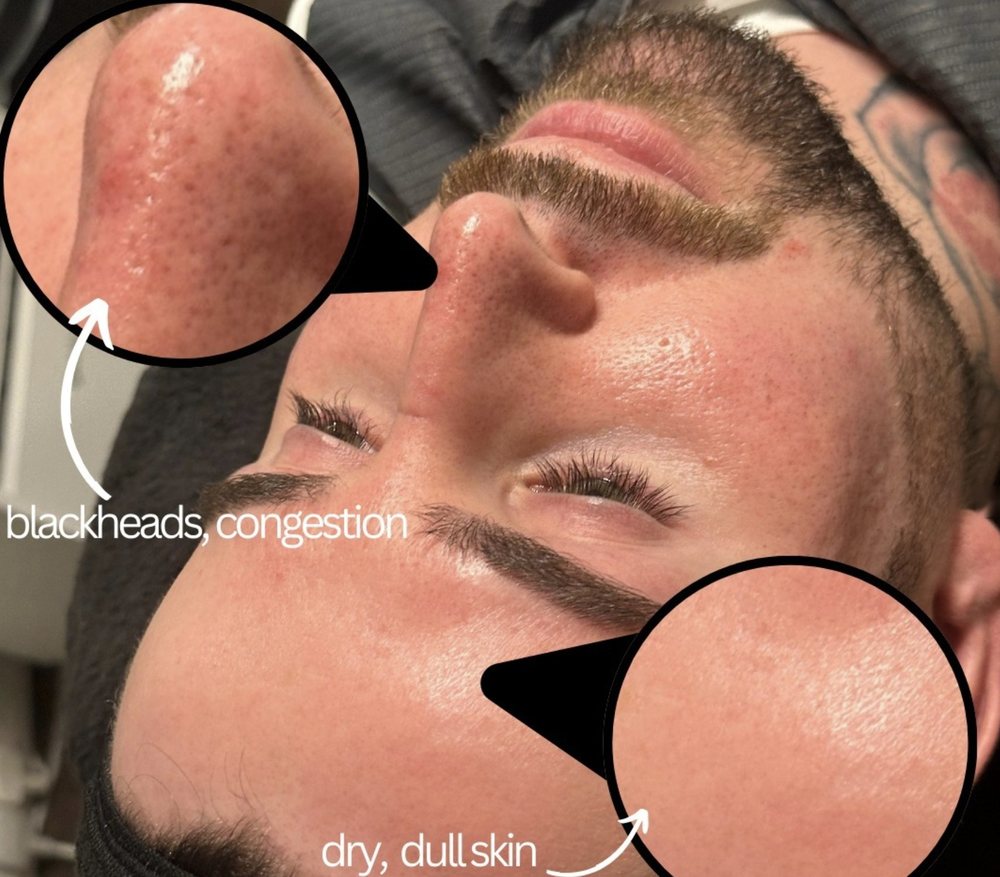 Before treatment