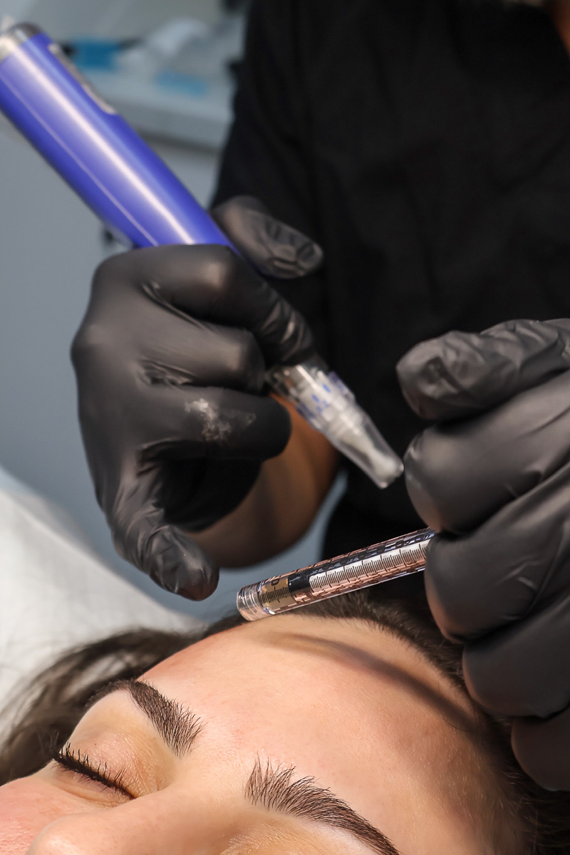 Why choose ReVita Med Clinic for SkinPen microneedling