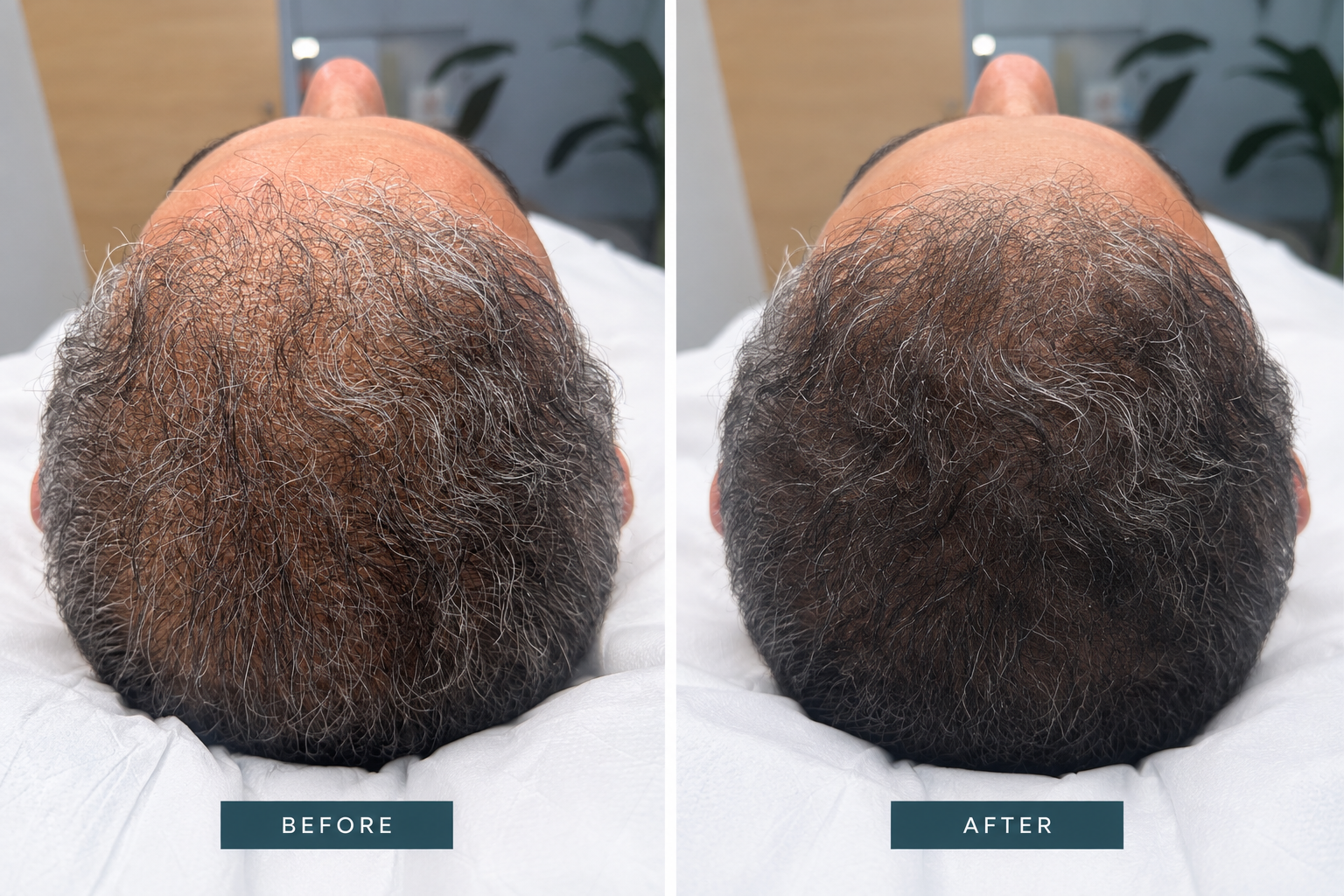 PRP hair treatment before and after result 2