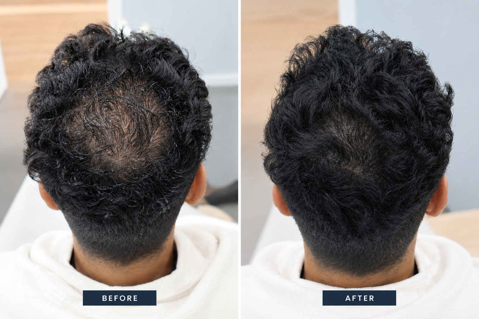 PRP hair treatment before and after result 3