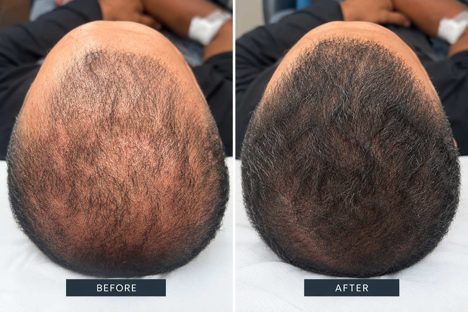 PRP hair treatment before and after result 1