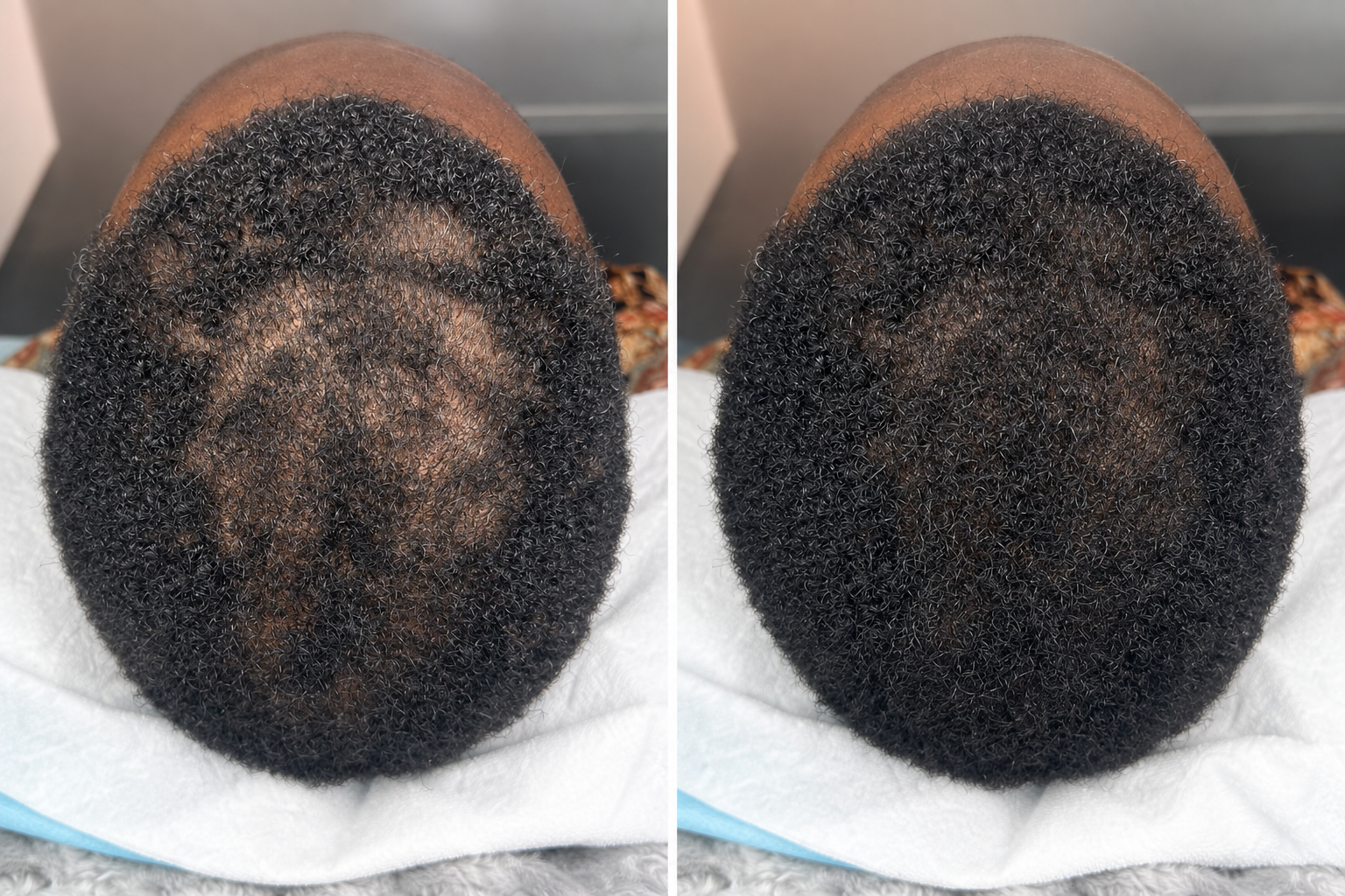 PRP hair treatment before and after result 4