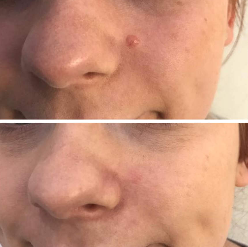 Skin tag removal before and after